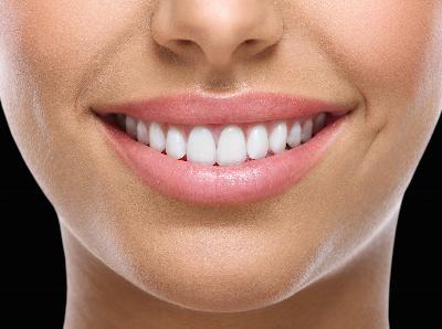 Invisalign